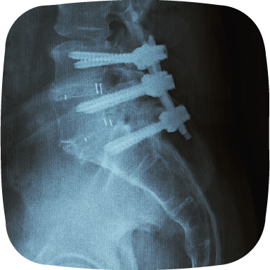 spine xray
