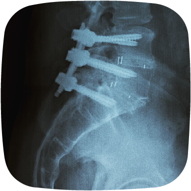 spine xray