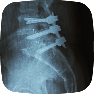 spine xray